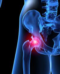 An Update on DePuy Metal-on-Metal Hip Replacements