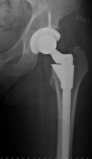 Biomet M2A-Magnum Metal-on-Metal Hip Replacements